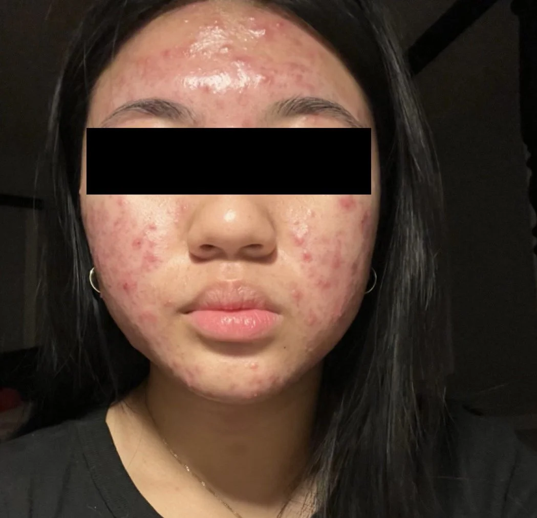 Close-up of a young woman's face with severe acne, redness, and inflammation