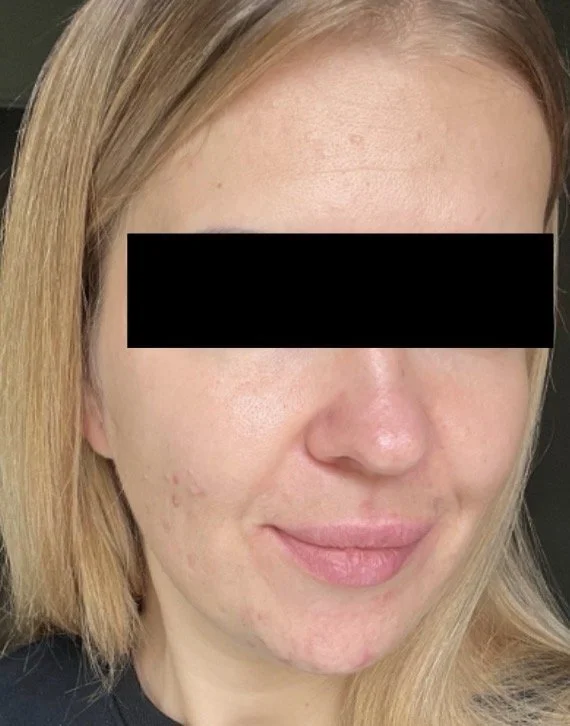 Naturopathic and holistic acne doctor Dr. Sheyda Vadipour helps you achieve lasting clear skin through functional lab testing, hormone and gut healing, and root-cause medicine.