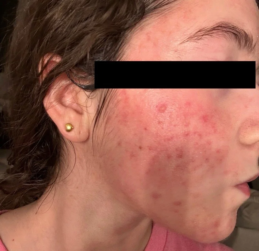 Close-up of a woman's face showing redness, inflammation, and acne on her cheek.