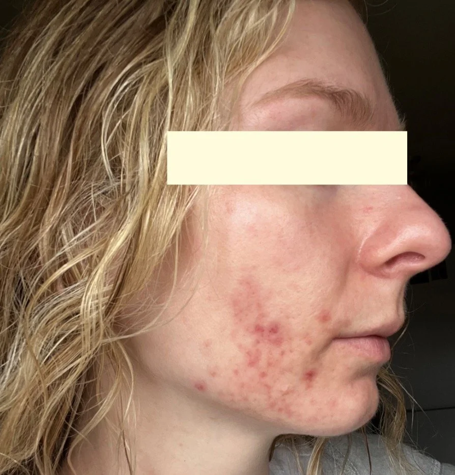 Naturopathic and holistic acne doctor, Dr. Sheyda Vadipour, helping you heal acne naturally and achieve clear skin through functional lab testing, hormone and gut healing, and root-cause medicine.