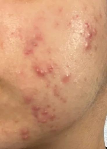 Close-up of skin with acne, including red pimples and bumps.