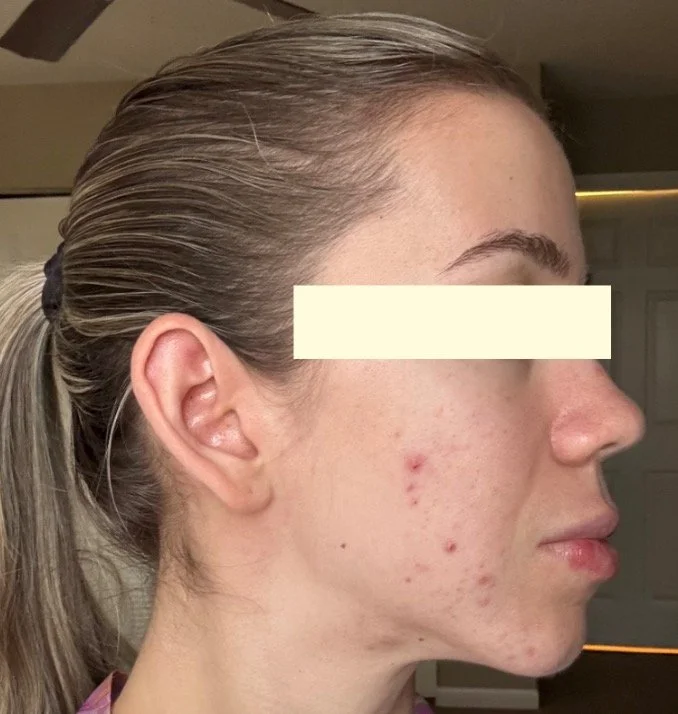 Naturopathic and holistic acne doctor, Dr. Sheyda Vadipour, helping you heal acne naturally and achieve clear skin through functional lab testing, hormone and gut healing, and root-cause medicine.