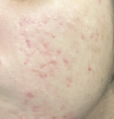 Close-up of skin with red, irritated, and inflamed pimples or acne.