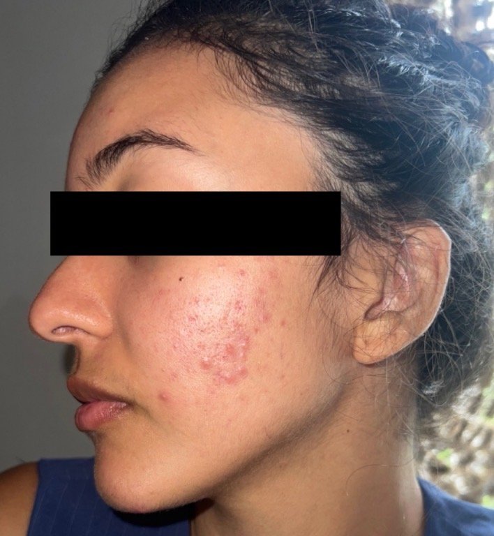 Naturopathic and holistic acne doctor Dr. Sheyda Vadipour helps you achieve lasting heal your acne naturally and achieve clear skin through functional lab testing, hormone and gut healing, and root-cause medicine.
