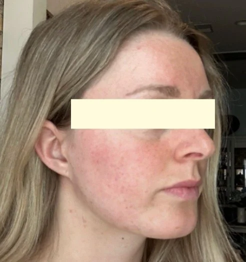 Naturopathic and holistic acne doctor Dr. Sheyda Vadipour helps you heal your acne naturally and achieve clear skin through functional lab testing, hormone and gut healing, and root-cause medicine.