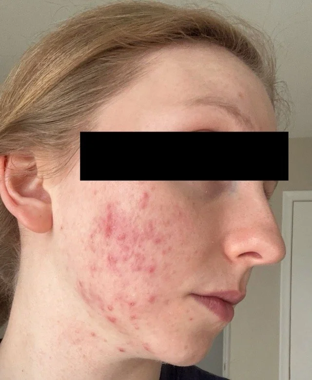 Naturopathic and holistic acne doctor Dr. Sheyda Vadipour helps you achieve lasting heal your acne naturally and achieve clear skin through functional lab testing, hormone and gut healing, and root-cause medicine.