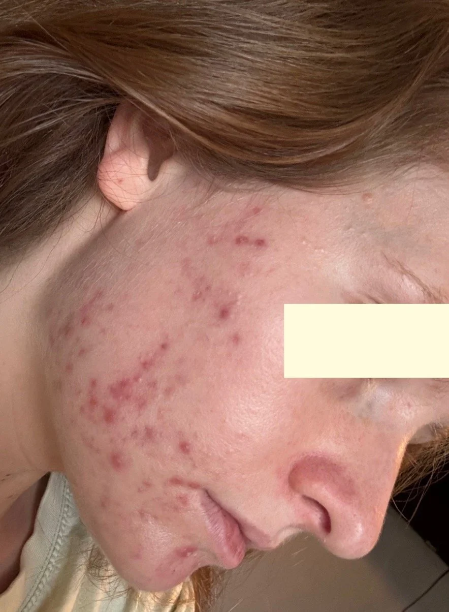 Naturopathic and holistic acne doctor, Dr. Sheyda Vadipour, helping you heal acne naturally and achieve clear skin through functional lab testing, hormone and gut healing, and root-cause medicine.