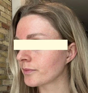 Naturopathic and holistic acne doctor Dr. Sheyda Vadipour helps you heal your acne naturally and achieve clear skin through functional lab testing, hormone and gut healing, and root-cause medicine.