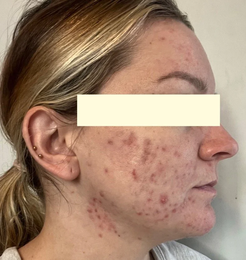 Naturopathic and holistic acne doctor, Dr. Sheyda Vadipour, helping you heal acne naturally and achieve clear skin through functional lab testing, hormone and gut healing, and root-cause medicine.