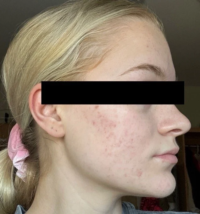 Naturopathic and holistic acne doctor Dr. Sheyda Vadipour helps you achieve lasting heal your acne naturally and achieve clear skin through functional lab testing, hormone and gut healing, and root-cause medicine.