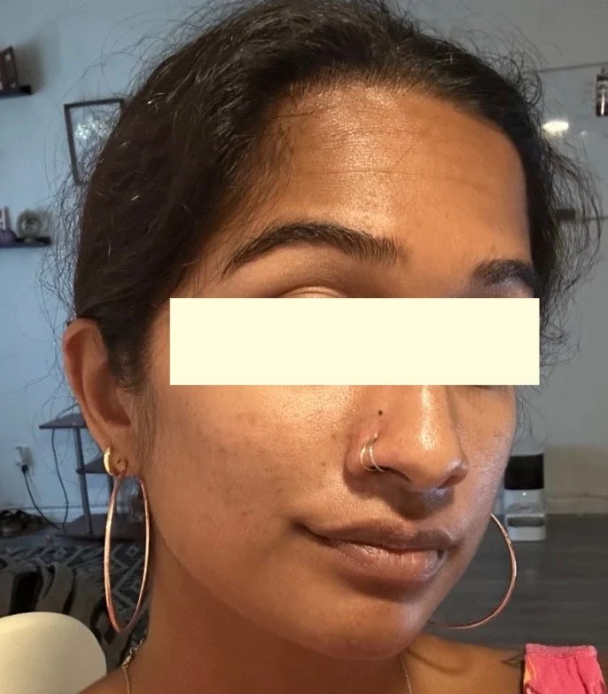 Naturopathic and holistic acne doctor Dr. Sheyda Vadipour helps you heal your acne naturally and achieve clear skin through functional lab testing, hormone and gut healing, and root-cause medicine.