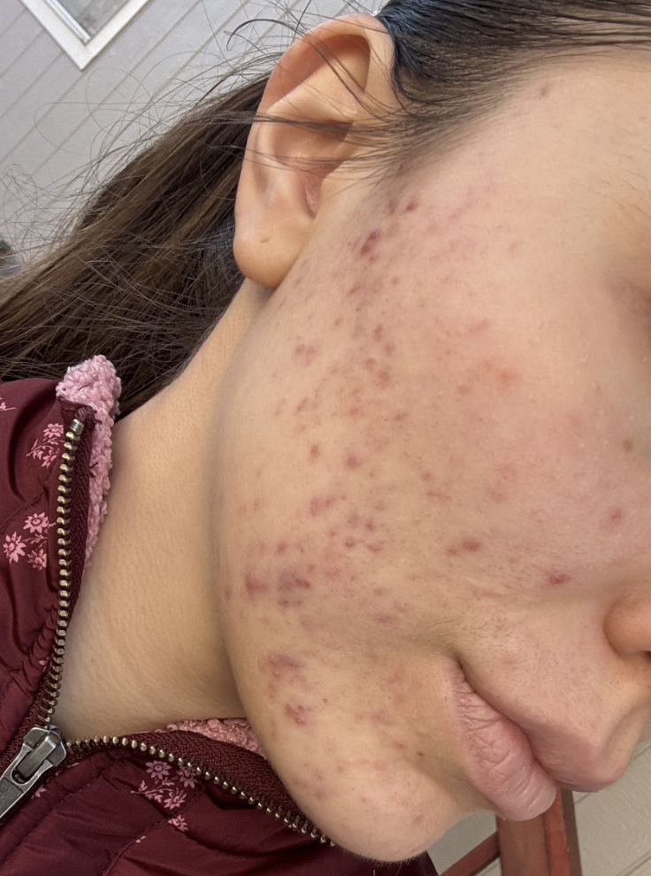 Naturopathic and holistic acne doctor, Dr. Sheyda Vadipour, helping you heal acne naturally and achieve clear skin through functional lab testing, hormone and gut healing, and root-cause medicine.
