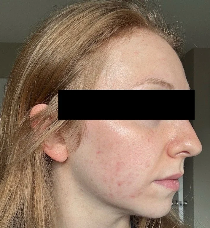 Naturopathic and holistic acne doctor Dr. Sheyda Vadipour helps you achieve lasting heal your acne naturally and achieve clear skin through functional lab testing, hormone and gut healing, and root-cause medicine.