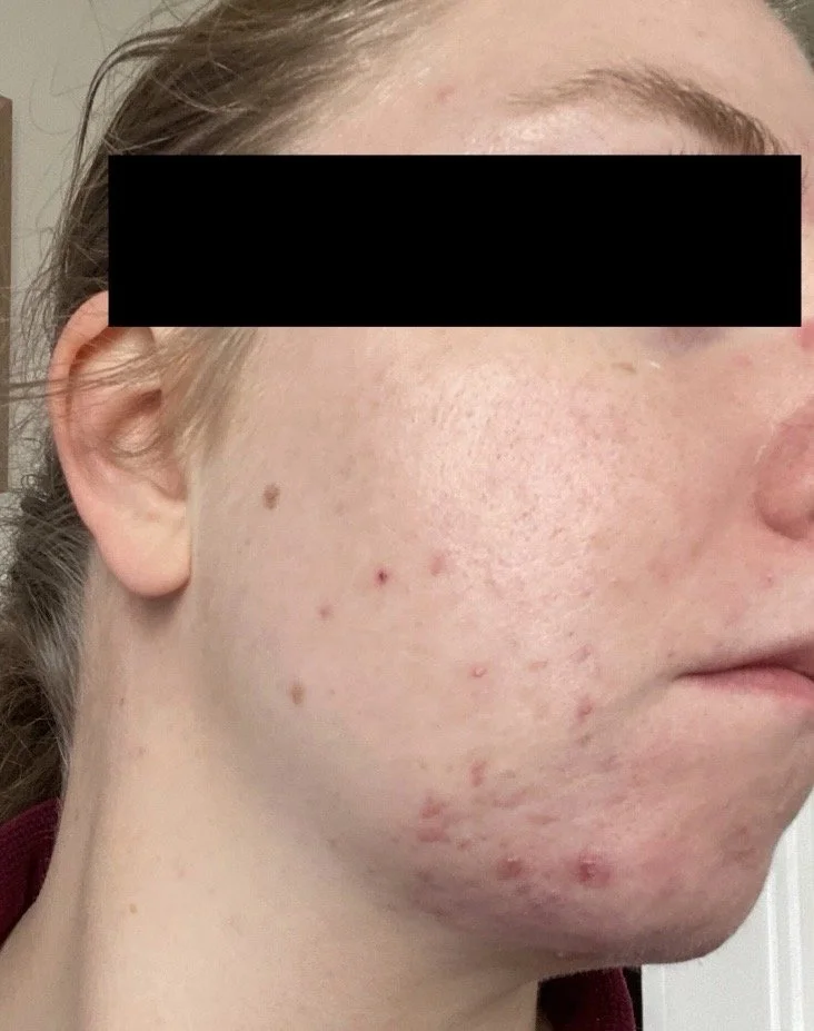 Naturopathic and holistic acne doctor Dr. Sheyda Vadipour helps you achieve lasting heal your acne naturally and achieve clear skin through functional lab testing, hormone and gut healing, and root-cause medicine.