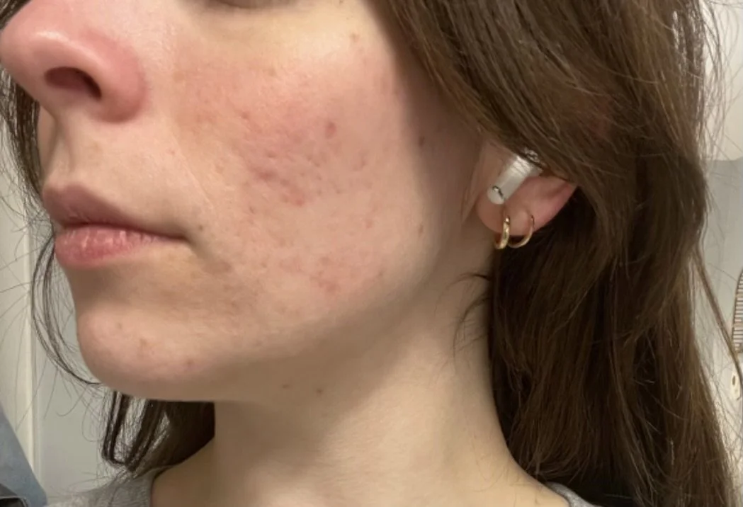 Naturopathic and holistic acne doctor Dr. Sheyda Vadipour helps you achieve lasting clear skin through functional lab testing, hormone and gut healing, and root-cause medicine.