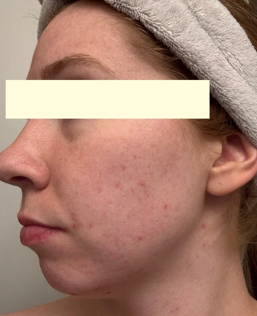 Naturopathic and holistic acne doctor Dr. Sheyda Vadipour helps you heal your acne naturally and achieve clear skin through functional lab testing, hormone and gut healing, and root-cause medicine.