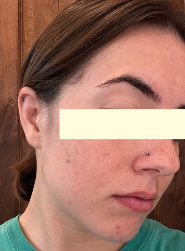 Naturopathic and holistic acne doctor Dr. Sheyda Vadipour helps you heal your acne naturally and achieve clear skin through functional lab testing, hormone and gut healing, and root-cause medicine.