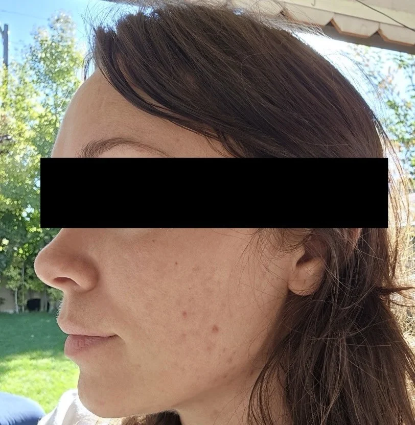 Naturopathic and holistic acne doctor Dr. Sheyda Vadipour helps you achieve lasting heal your acne naturally and achieve clear skin through functional lab testing, hormone and gut healing, and root-cause medicine.