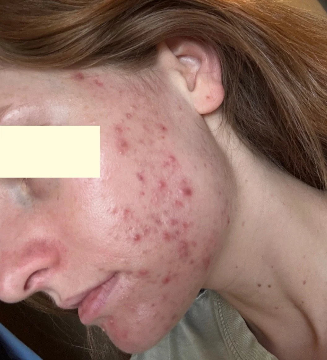 Naturopathic and holistic acne doctor, Dr. Sheyda Vadipour, helping you heal acne naturally and achieve clear skin through functional lab testing, hormone and gut healing, and root-cause medicine.