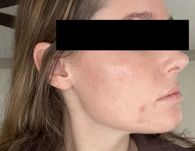 Naturopathic and holistic acne doctor Dr. Sheyda Vadipour helps you achieve lasting clear skin through functional lab testing, hormone and gut healing, and root-cause medicine.