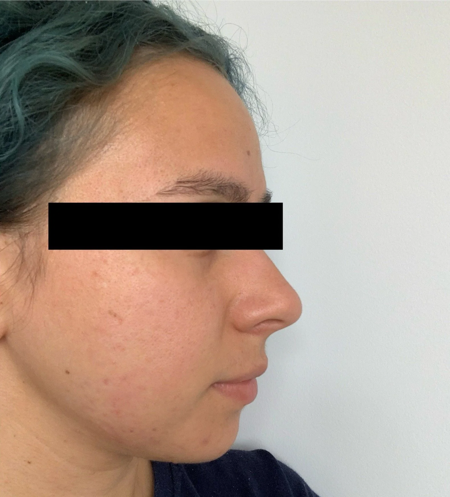 Naturopathic and holistic acne doctor Dr. Sheyda Vadipour helps you achieve lasting heal your acne naturally and achieve clear skin through functional lab testing, hormone and gut healing, and root-cause medicine.