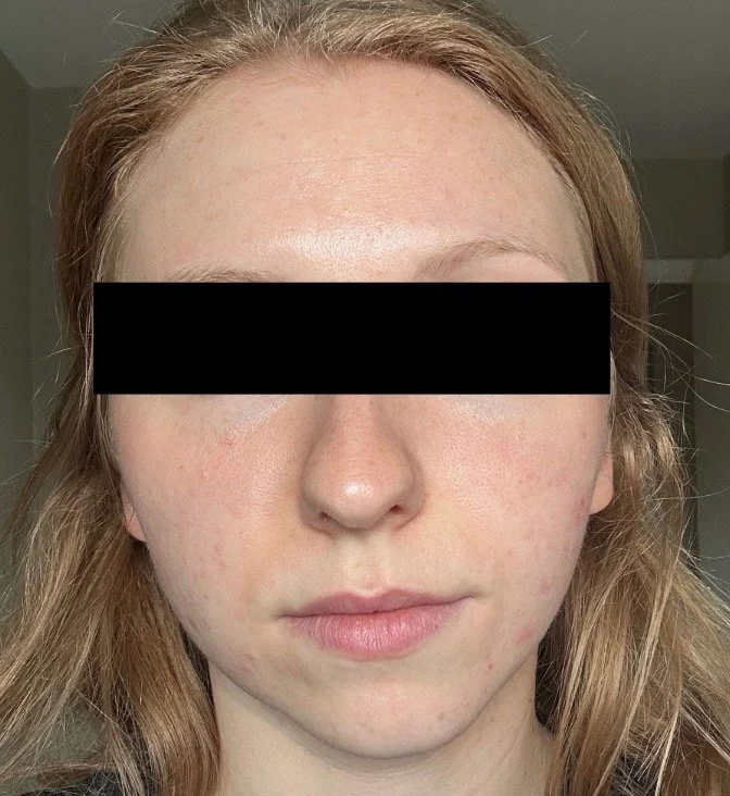 Naturopathic and holistic acne doctor Dr. Sheyda Vadipour helps you achieve lasting heal your acne naturally and achieve clear skin through functional lab testing, hormone and gut healing, and root-cause medicine.