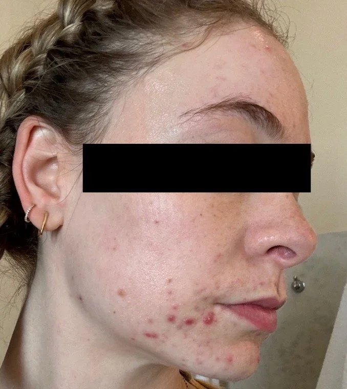 Naturopathic and holistic acne doctor Dr. Sheyda Vadipour helps you achieve lasting clear skin through functional lab testing, hormone and gut healing, and root-cause medicine.