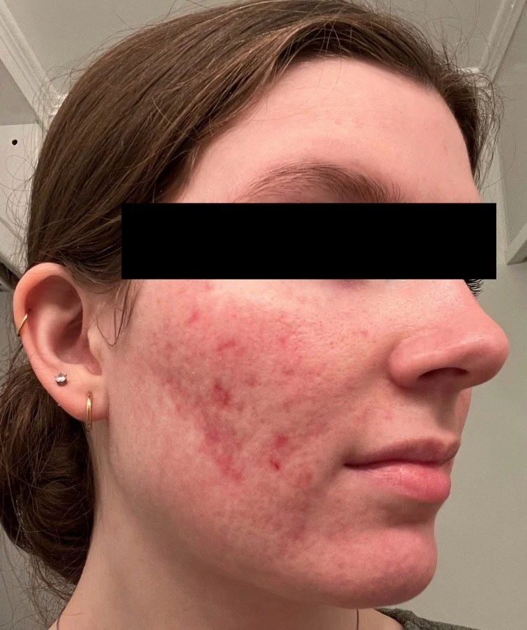 Naturopathic and holistic acne doctor, Dr. Sheyda Vadipour, helping you heal acne naturally and achieve clear skin through functional lab testing, hormone and gut healing, and root-cause medicine.