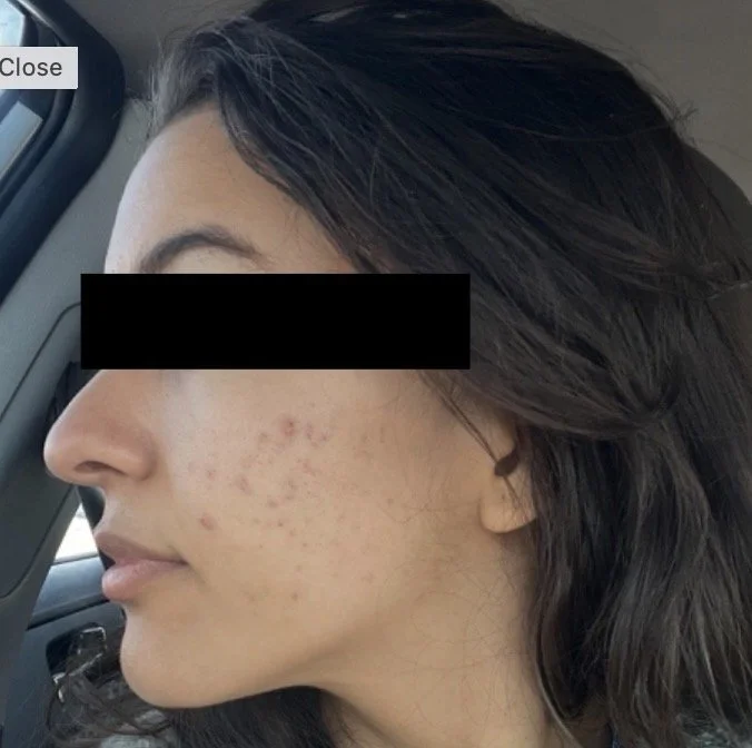 Naturopathic and holistic acne doctor Dr. Sheyda Vadipour helps you achieve lasting heal your acne naturally and achieve clear skin through functional lab testing, hormone and gut healing, and root-cause medicine.