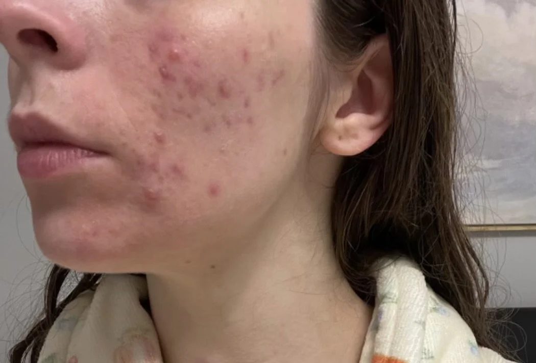 Close-up of a person's face showing moderate acne with red bumps and pimples on the cheek and jawline.