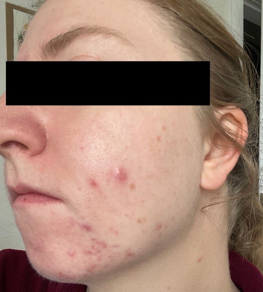 Naturopathic and holistic acne doctor Dr. Sheyda Vadipour helps you achieve lasting heal your acne naturally and achieve clear skin through functional lab testing, hormone and gut healing, and root-cause medicine.