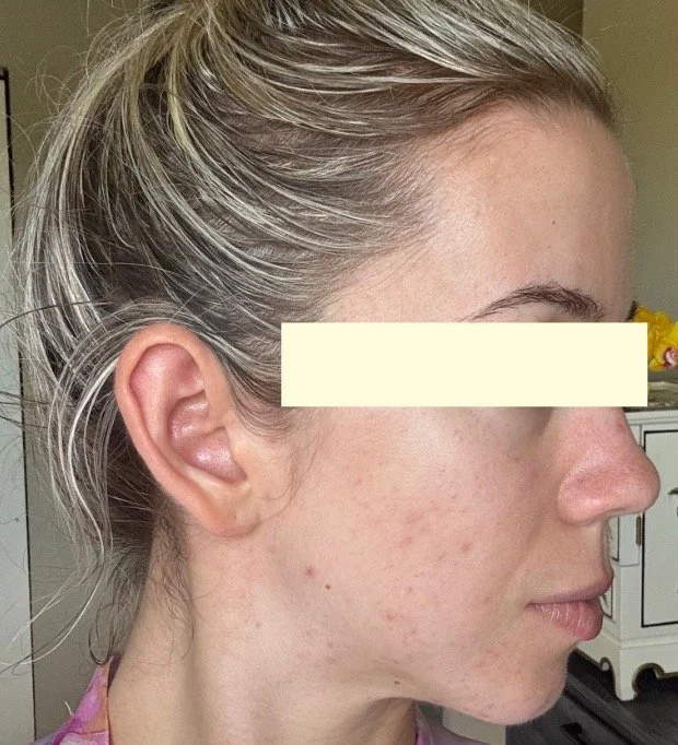 Naturopathic and holistic acne doctor, Dr. Sheyda Vadipour, helping you heal acne naturally and achieve clear skin through functional lab testing, hormone and gut healing, and root-cause medicine.