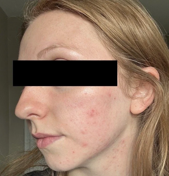 Naturopathic and holistic acne doctor Dr. Sheyda Vadipour helps you achieve lasting heal your acne naturally and achieve clear skin through functional lab testing, hormone and gut healing, and root-cause medicine.