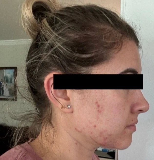 Naturopathic and holistic acne doctor Dr. Sheyda Vadipour helps you achieve lasting clear skin through functional lab testing, hormone and gut healing, and root-cause medicine.