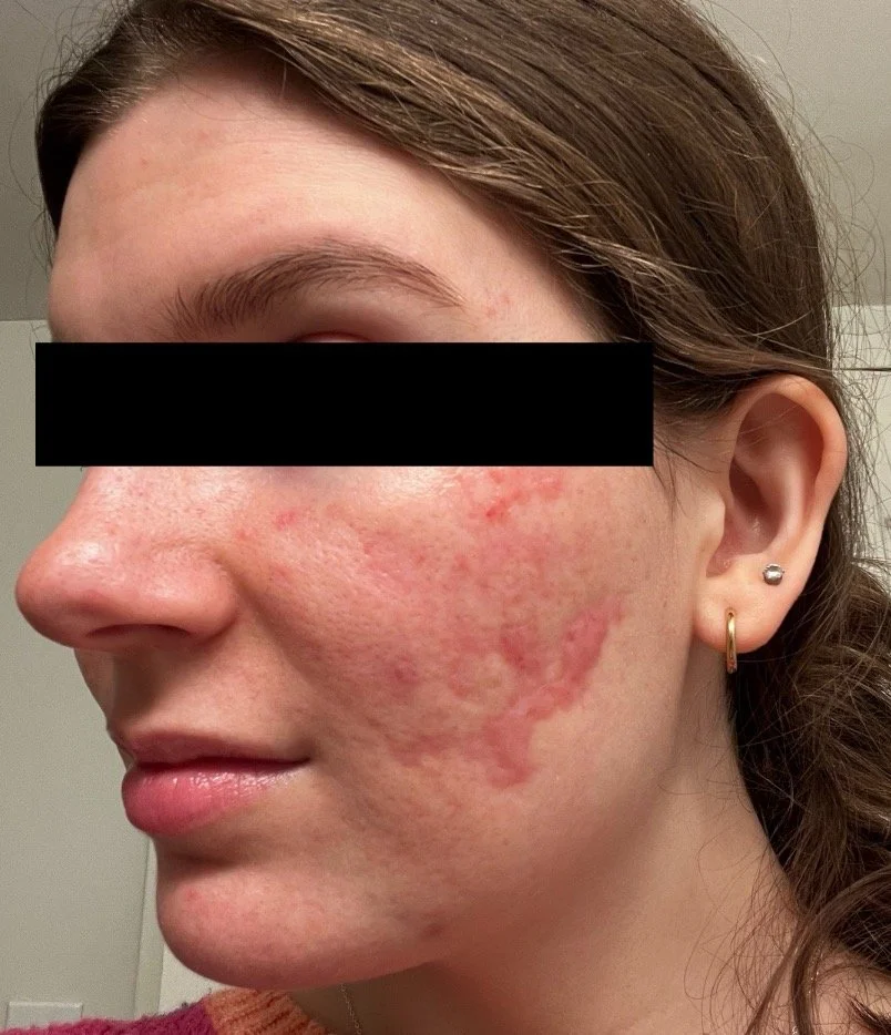 Naturopathic and holistic acne doctor, Dr. Sheyda Vadipour, helping you heal acne naturally and achieve clear skin through functional lab testing, hormone and gut healing, and root-cause medicine.