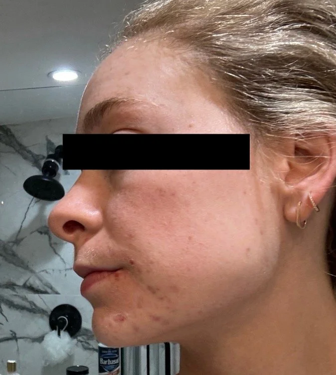 Naturopathic and holistic acne doctor Dr. Sheyda Vadipour helps you achieve lasting clear skin through functional lab testing, hormone and gut healing, and root-cause medicine.