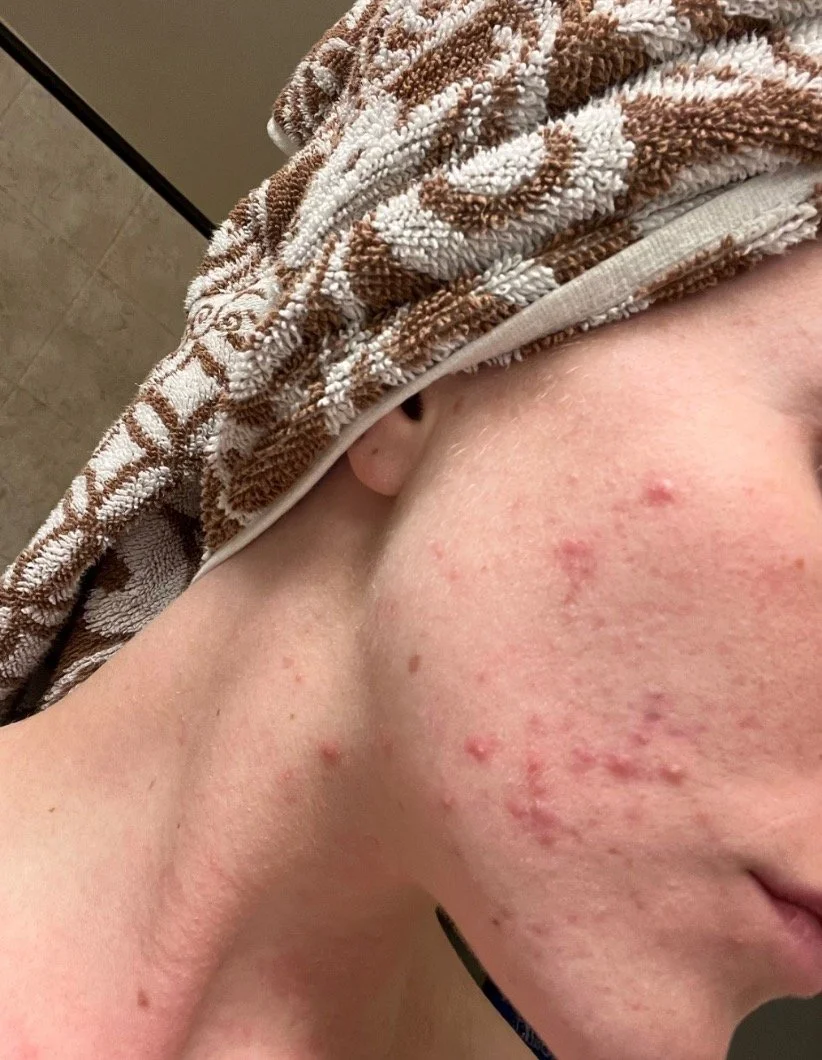 Naturopathic and holistic acne doctor Dr. Sheyda Vadipour helps you heal your acne naturally and achieve clear skin through functional lab testing, hormone and gut healing, and root-cause medicine.