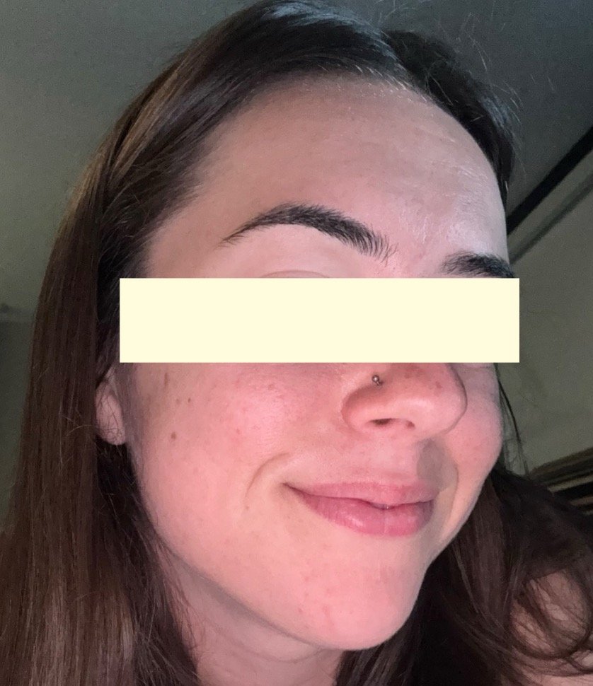 Naturopathic and holistic acne doctor Dr. Sheyda Vadipour helps you heal your acne naturally and achieve clear skin through functional lab testing, hormone and gut healing, and root-cause medicine.