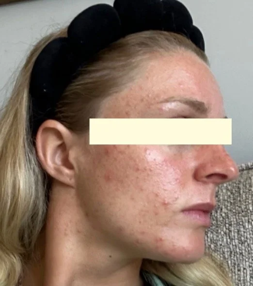 Naturopathic and holistic acne doctor Dr. Sheyda Vadipour helps you heal your acne naturally and achieve clear skin through functional lab testing, hormone and gut healing, and root-cause medicine.
