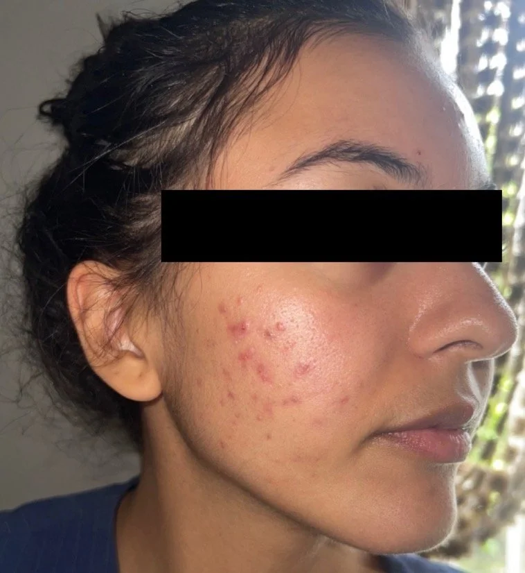 Naturopathic and holistic acne doctor Dr. Sheyda Vadipour helps you heal your acne naturally and achieve clear skin through functional lab testing, hormone and gut healing, and root-cause medicine.