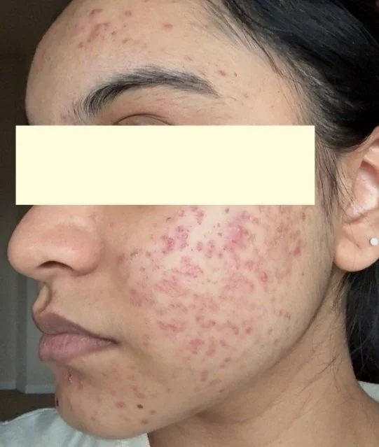 Naturopathic and holistic acne doctor Dr. Sheyda Vadipour helps you heal your acne naturally and achieve clear skin through functional lab testing, hormone and gut healing, and root-cause medicine.