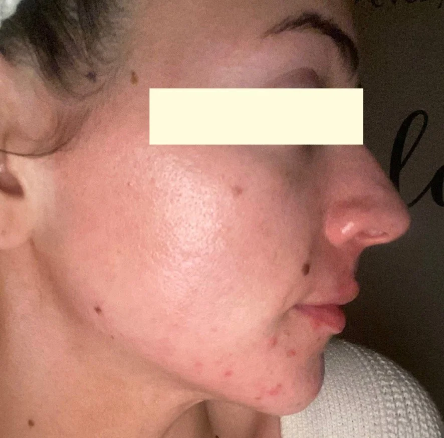 Naturopathic and holistic acne doctor, Dr. Sheyda Vadipour, helping you heal acne naturally and achieve clear skin through functional lab testing, hormone and gut healing, and root-cause medicine.
