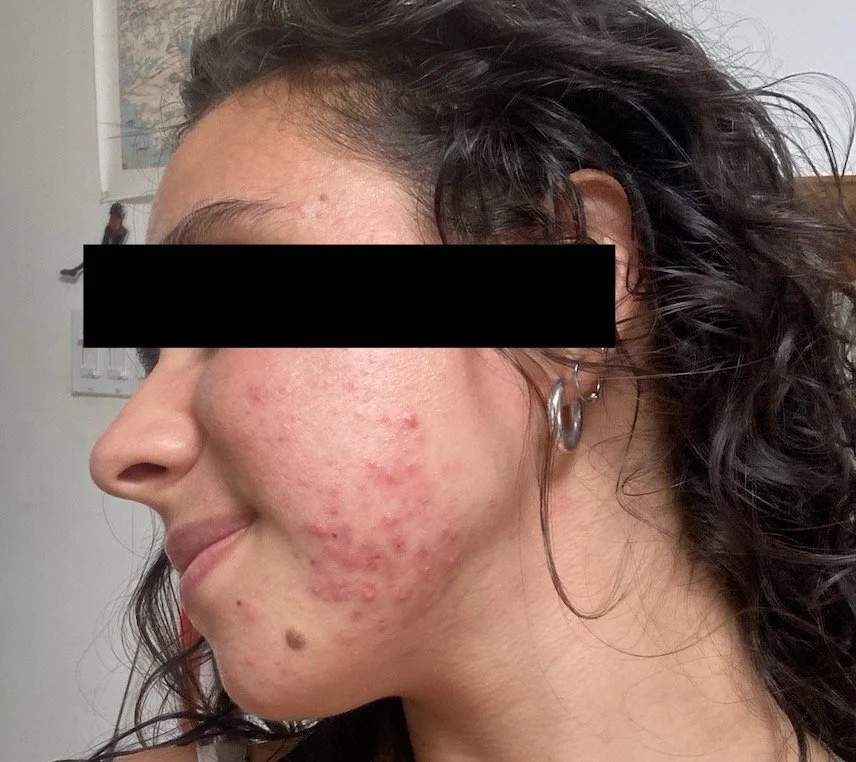 Naturopathic and holistic acne doctor Dr. Sheyda Vadipour helps you achieve lasting heal your acne naturally and achieve clear skin through functional lab testing, hormone and gut healing, and root-cause medicine.