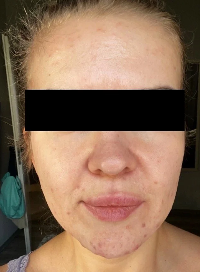 Naturopathic and holistic acne doctor Dr. Sheyda Vadipour helps you achieve lasting clear skin through functional lab testing, hormone and gut healing, and root-cause medicine.