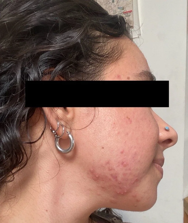 Naturopathic and holistic acne doctor Dr. Sheyda Vadipour helps you achieve lasting heal your acne naturally and achieve clear skin through functional lab testing, hormone and gut healing, and root-cause medicine.