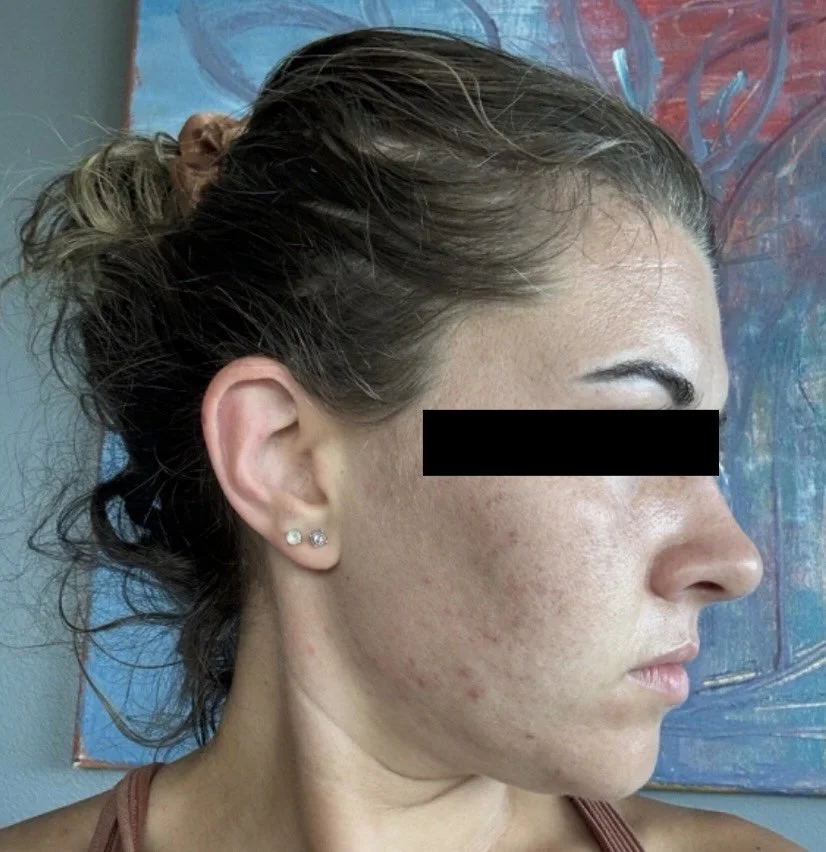 Naturopathic and holistic acne doctor Dr. Sheyda Vadipour helps you achieve lasting clear skin through functional lab testing, hormone and gut healing, and root-cause medicine.