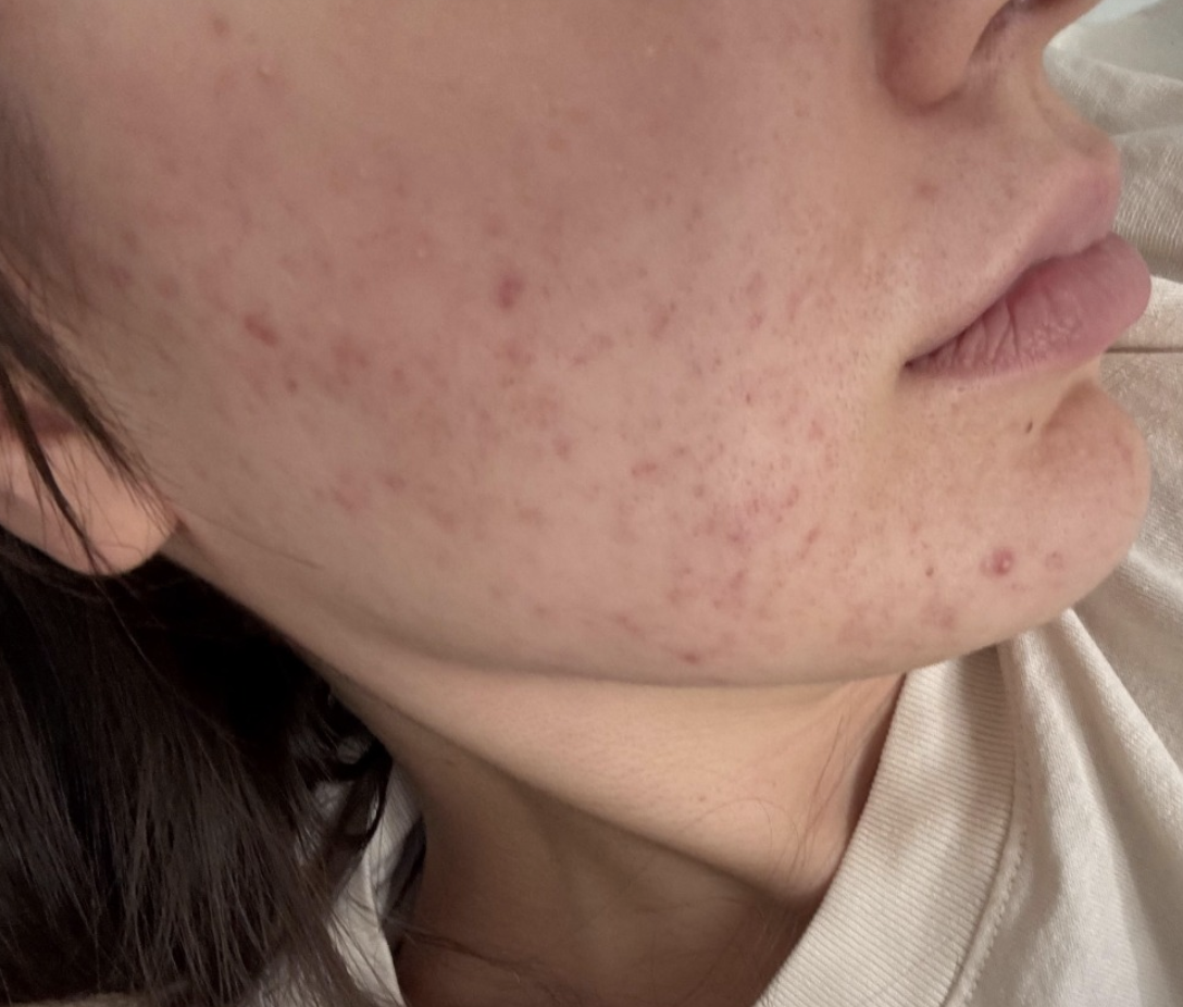 Naturopathic and holistic acne doctor, Dr. Sheyda Vadipour, helping you heal acne naturally and achieve clear skin through functional lab testing, hormone and gut healing, and root-cause medicine.