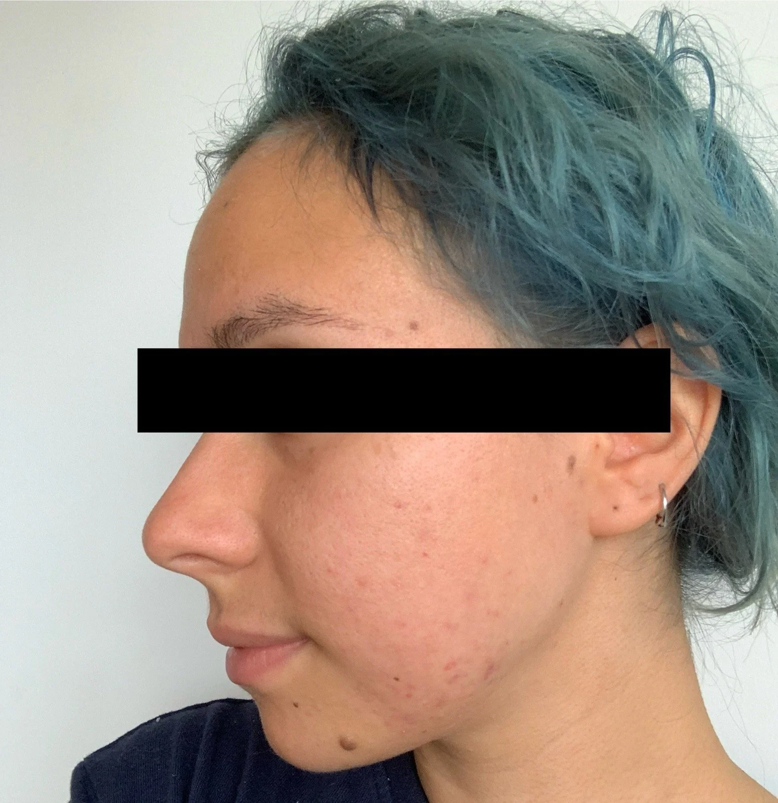 Naturopathic and holistic acne doctor Dr. Sheyda Vadipour helps you achieve lasting heal your acne naturally and achieve clear skin through functional lab testing, hormone and gut healing, and root-cause medicine.