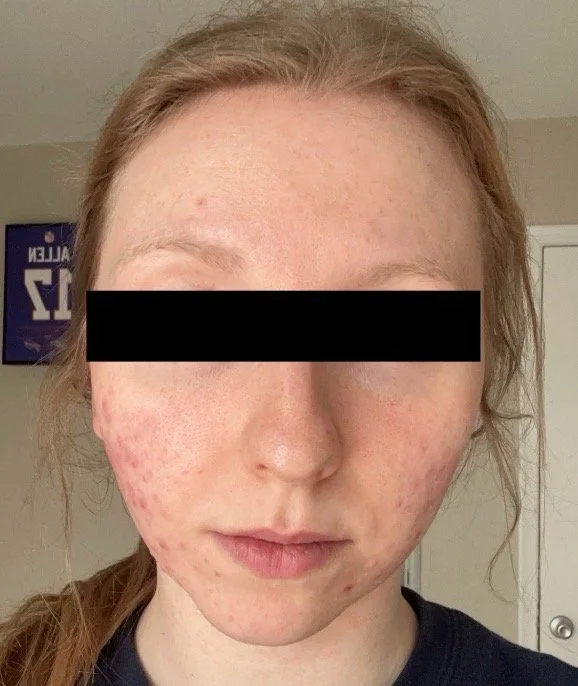 Naturopathic and holistic acne doctor Dr. Sheyda Vadipour helps you achieve lasting heal your acne naturally and achieve clear skin through functional lab testing, hormone and gut healing, and root-cause medicine.