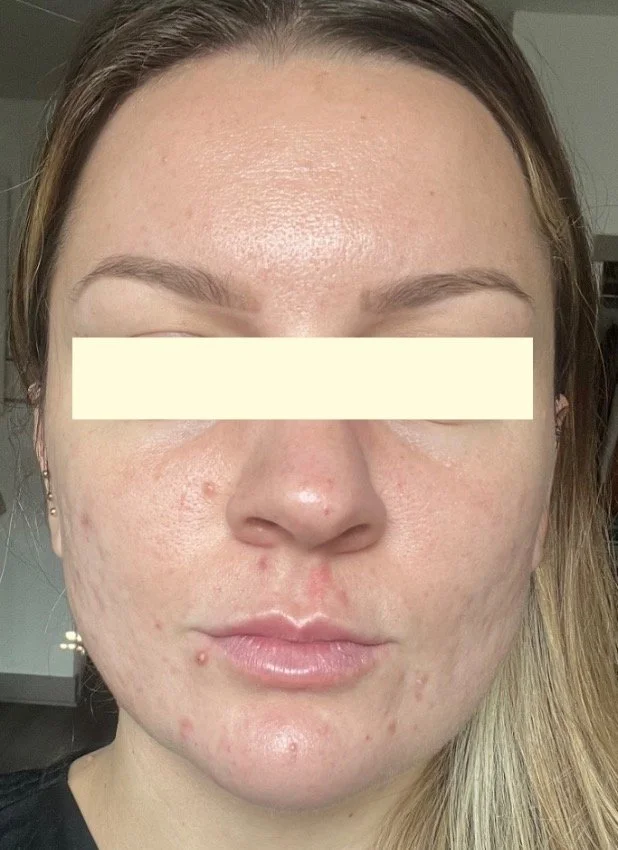 Naturopathic and holistic acne doctor, Dr. Sheyda Vadipour, helping you heal acne naturally and achieve clear skin through functional lab testing, hormone and gut healing, and root-cause medicine.